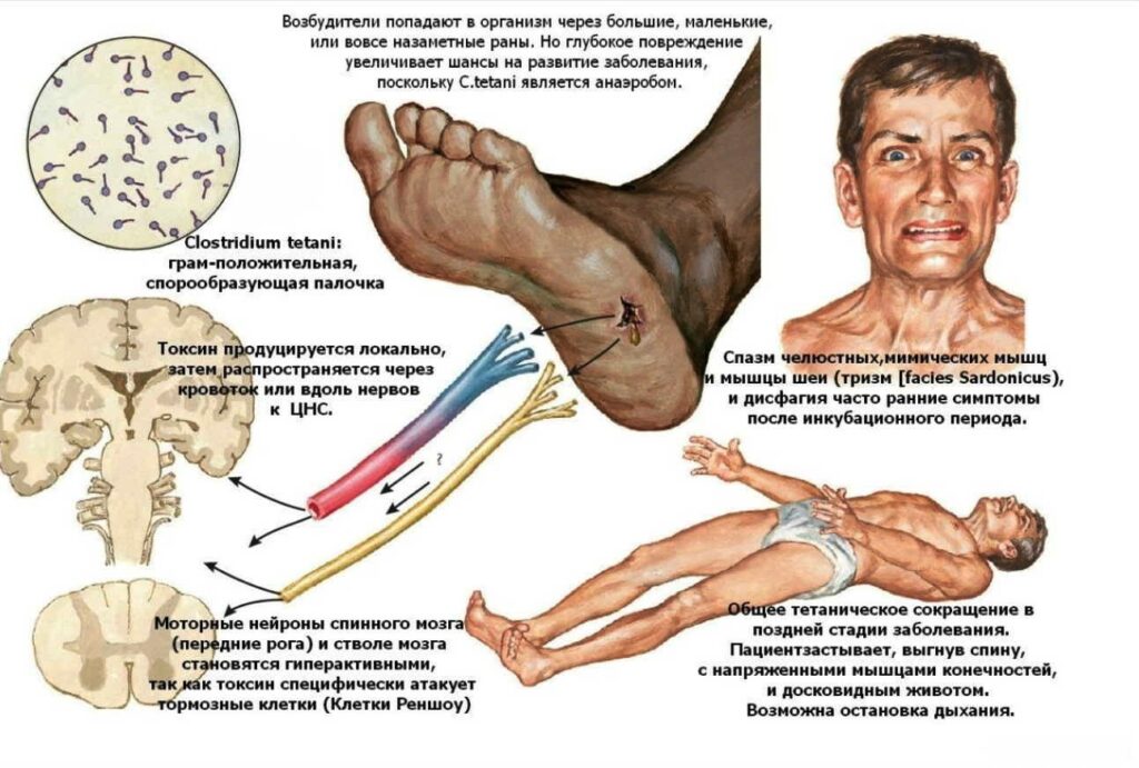 Столбняк